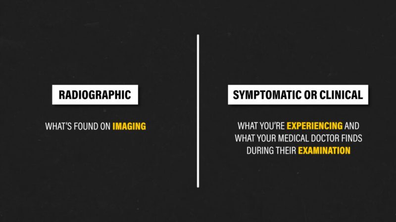 Hip Osteoarthritis Differences