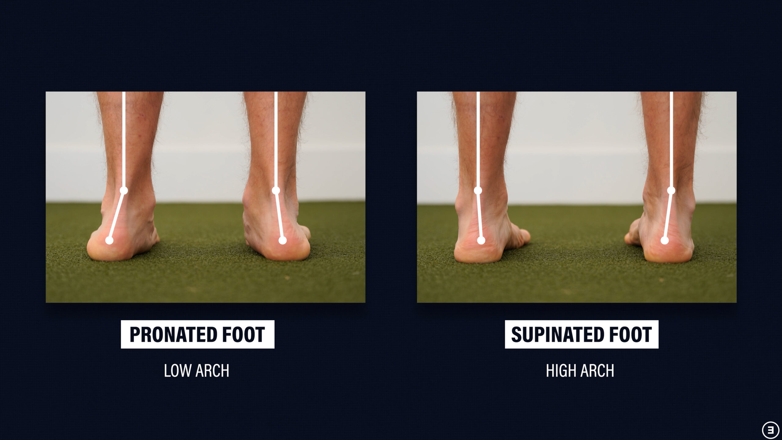 Flat Feet
